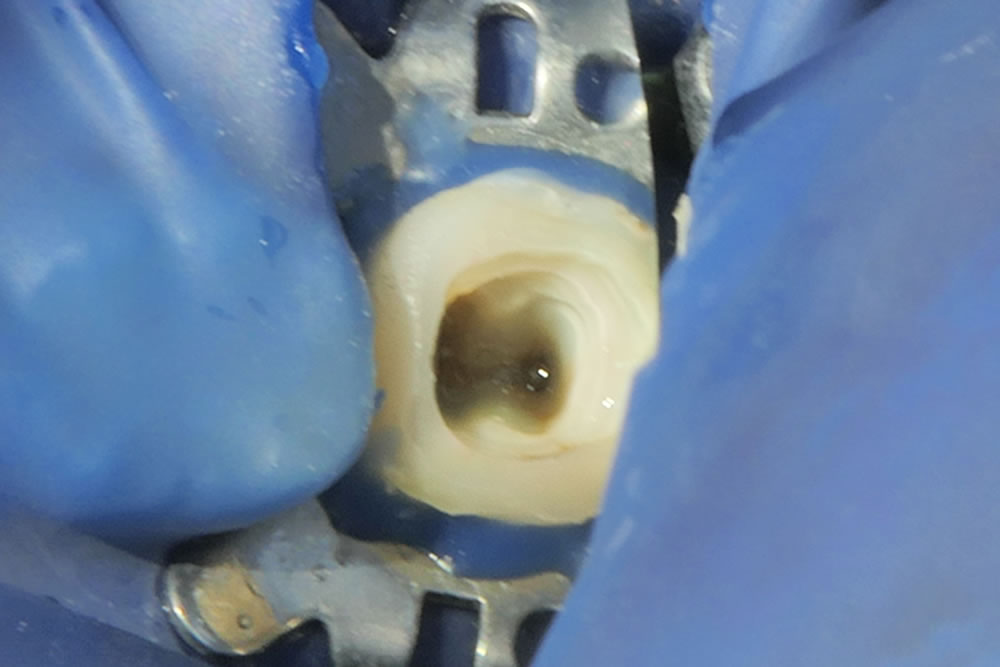 精密根管治療の実施