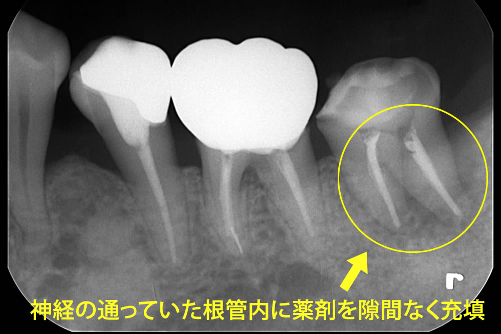 根管治療直後のレントゲン画像